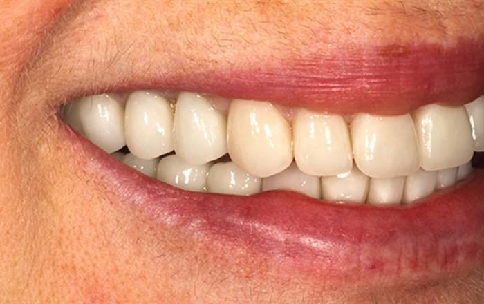 After treatment at Chroma Dental