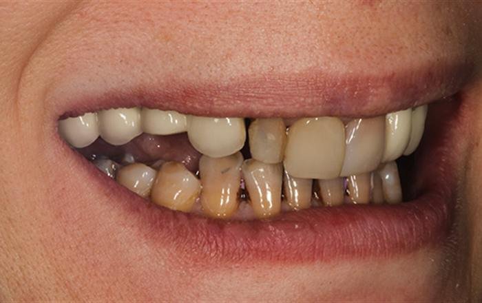 Before treatment at Chroma Dental