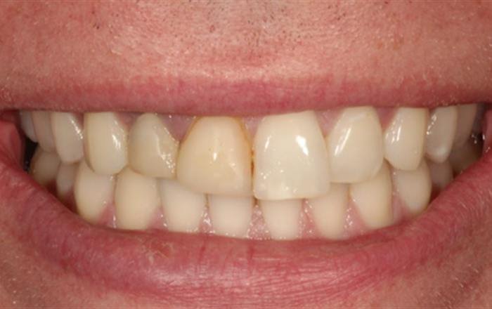 Before treatment at Chroma Dental
