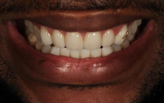 After treatment at Chroma Dental