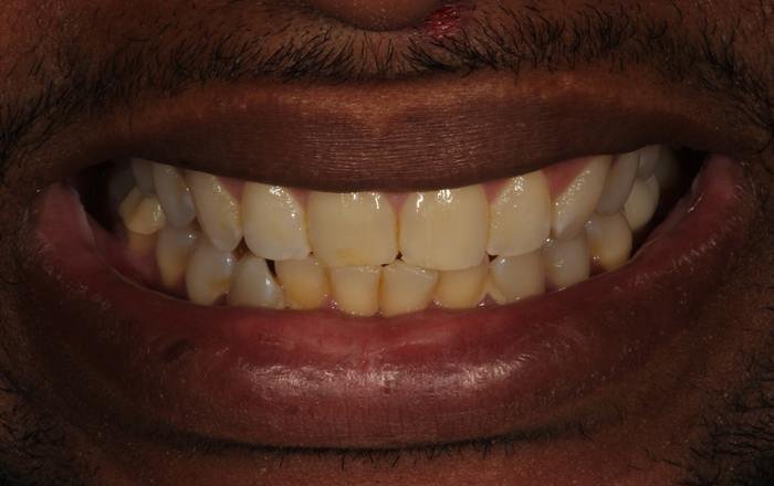 Before treatment at Chroma Dental