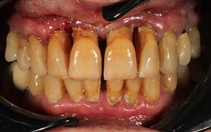 Before treatment at Chroma Dental