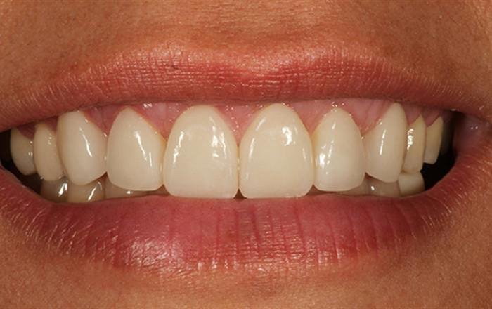 After treatment at Chroma Dental