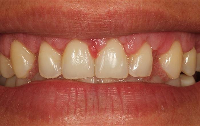 Before treatment at Chroma Dental