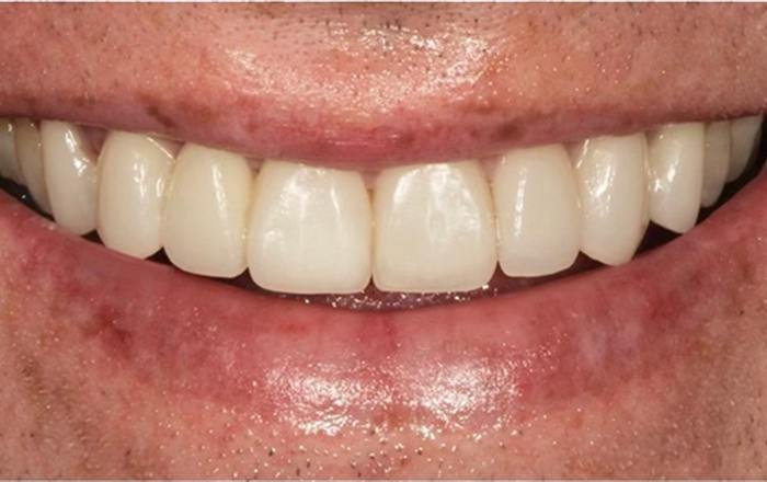 After treatment at Chroma Dental