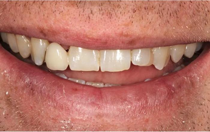 Before treatment at Chroma Dental