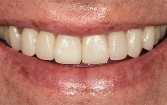 After treatment at Chroma Dental