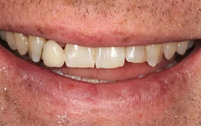 Before treatment at Chroma Dental