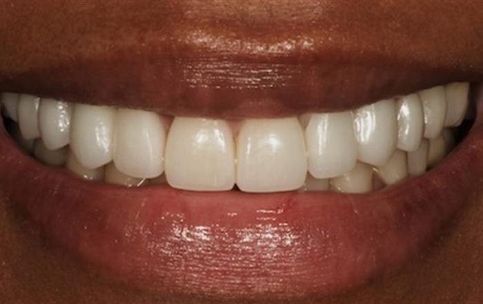 After treatment at Chroma Dental