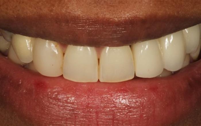 Before treatment at Chroma Dental