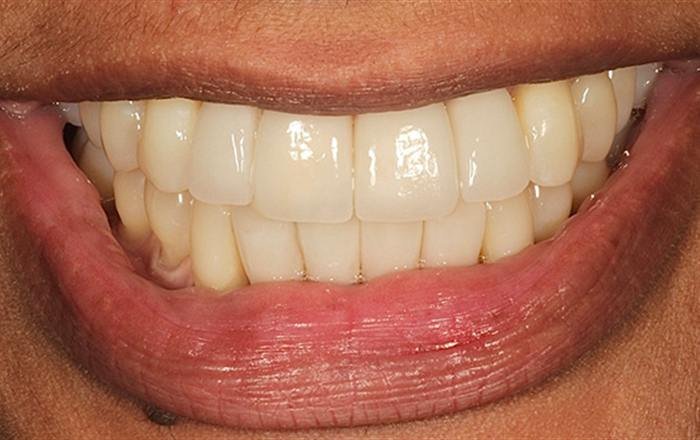 After treatment at Chroma Dental