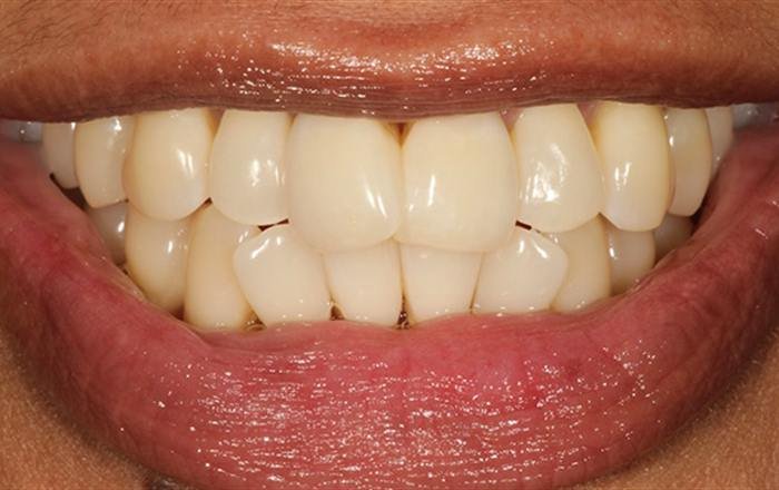 Before treatment at Chroma Dental