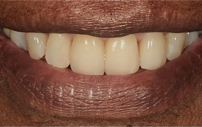 After treatment at Chroma Dental