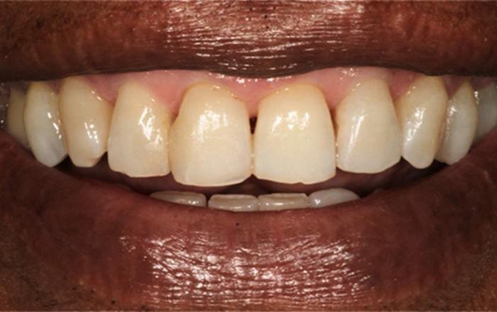 Before treatment at Chroma Dental