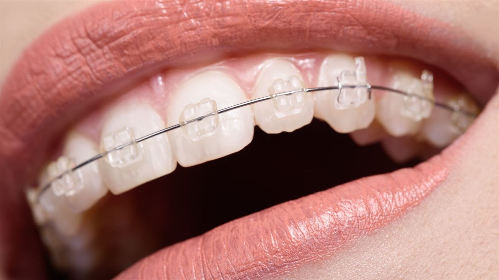 Clear and Ceramic Braces landing page hero
