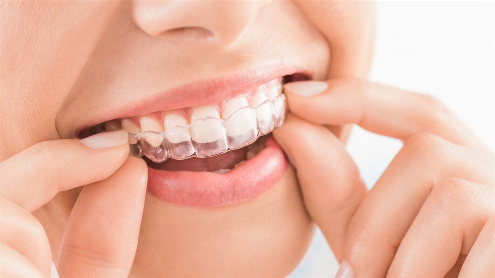 Invisalign landing page hero