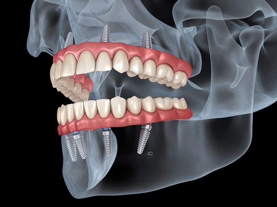 Illustration of a full arch of teeth supported on four dental implants